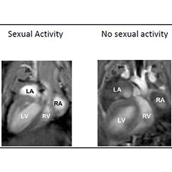MRI showing that sexual activity prevents heart enlargement and development of heart failure